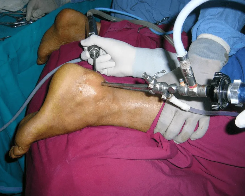Arthroscopy Surgery image 1