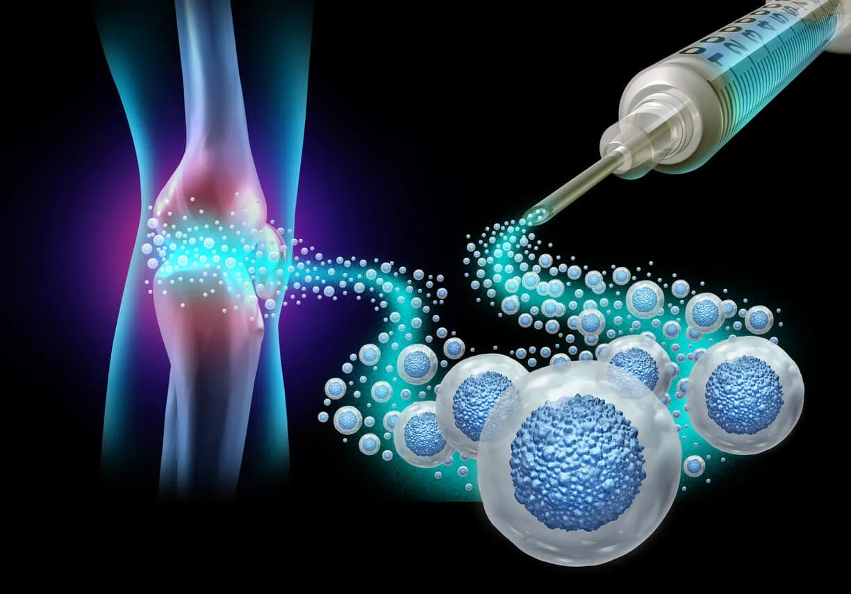 Viscosupplementation, Stem cell injections image 1