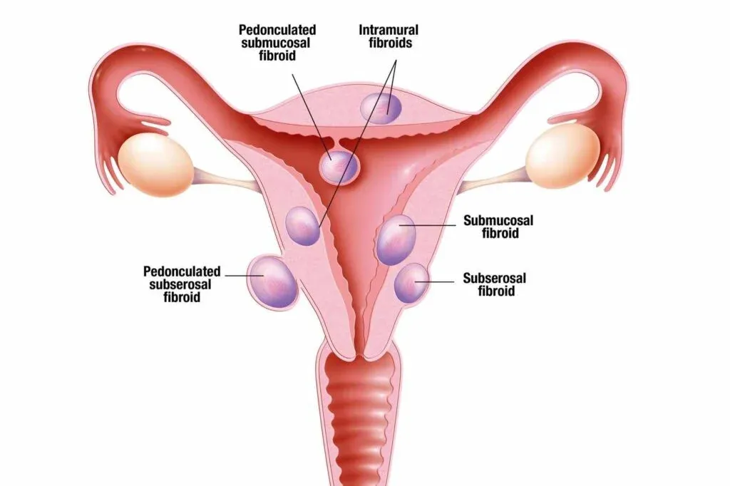 Fibroids Treatment image 1
