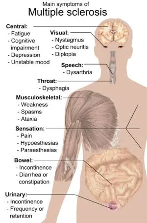 Multiple Sclerosis image 3