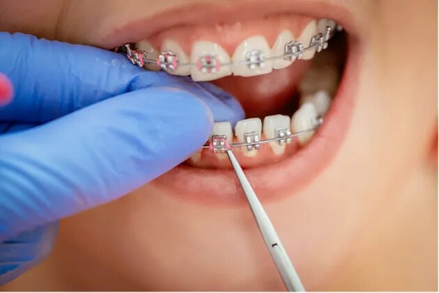 Modern Braces, Designed for Better Smiles image 1