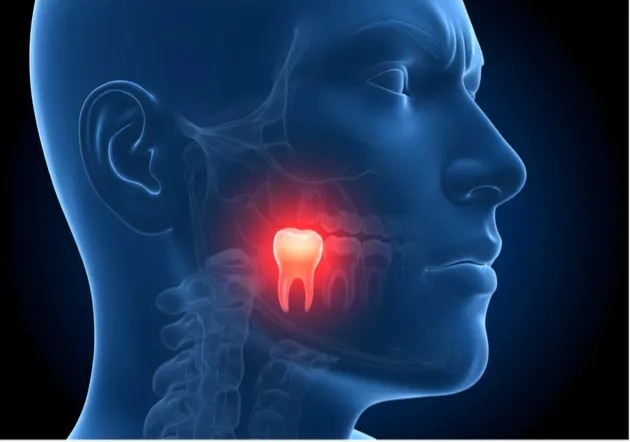 Wisdom Teeth Removal to Relieve Pain and Jaw Discomfort image 1
