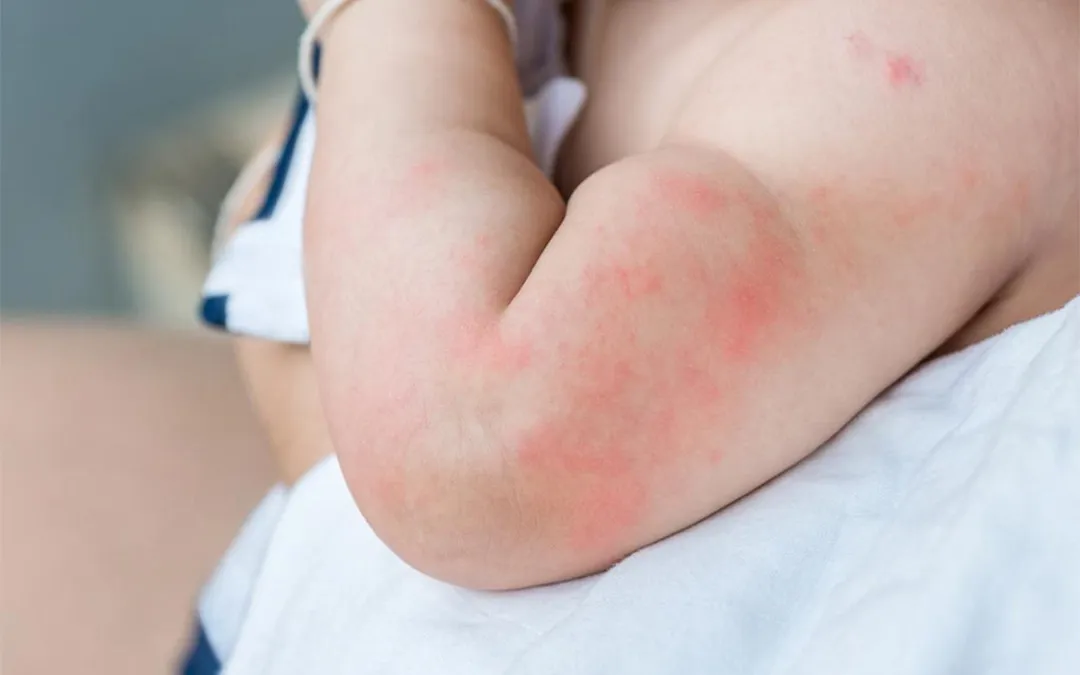 Common Allergies in Children image 1
