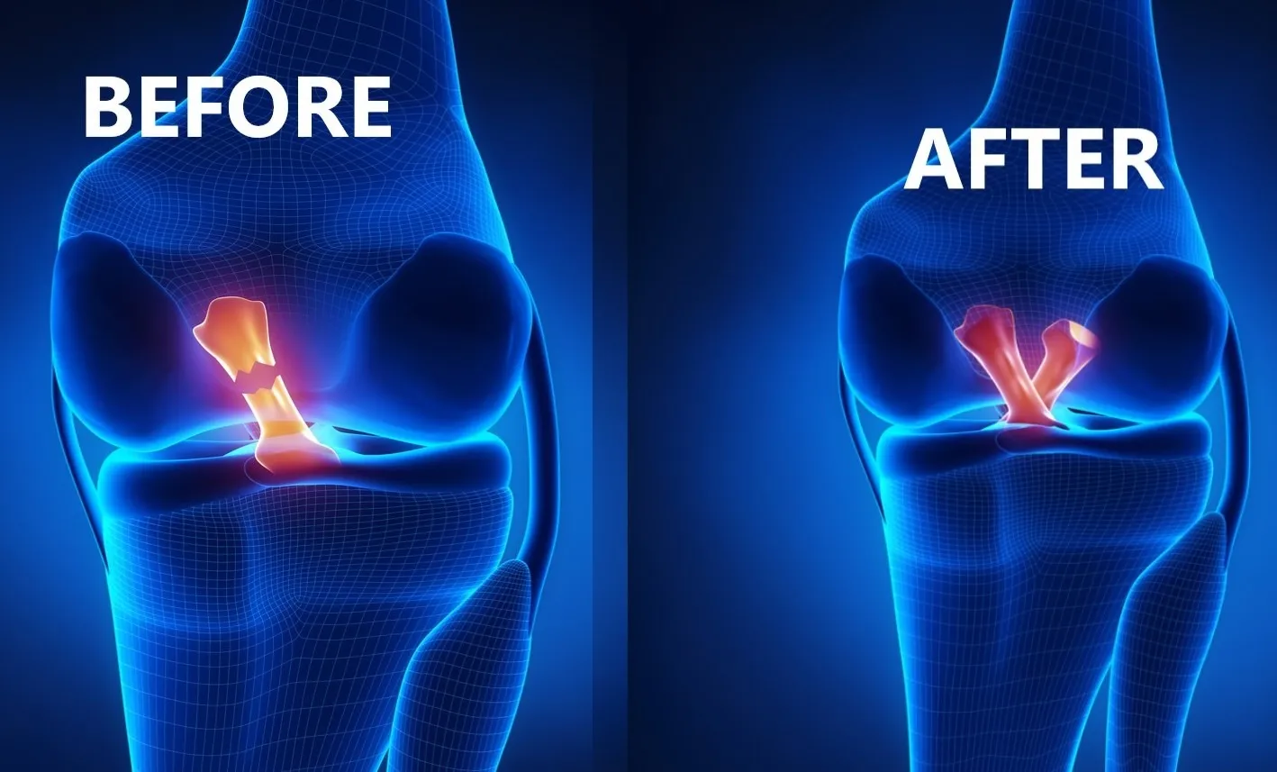 ACL Surgeon in Bibwewadi, Dhankawadi, Kondhwa, Undri, Wanowrie, Pune image 1
