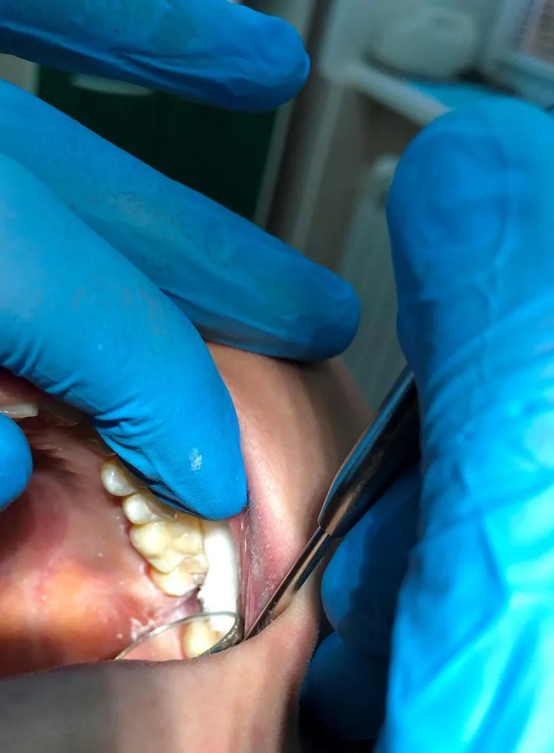 Tooth-Colored Fillings image 1