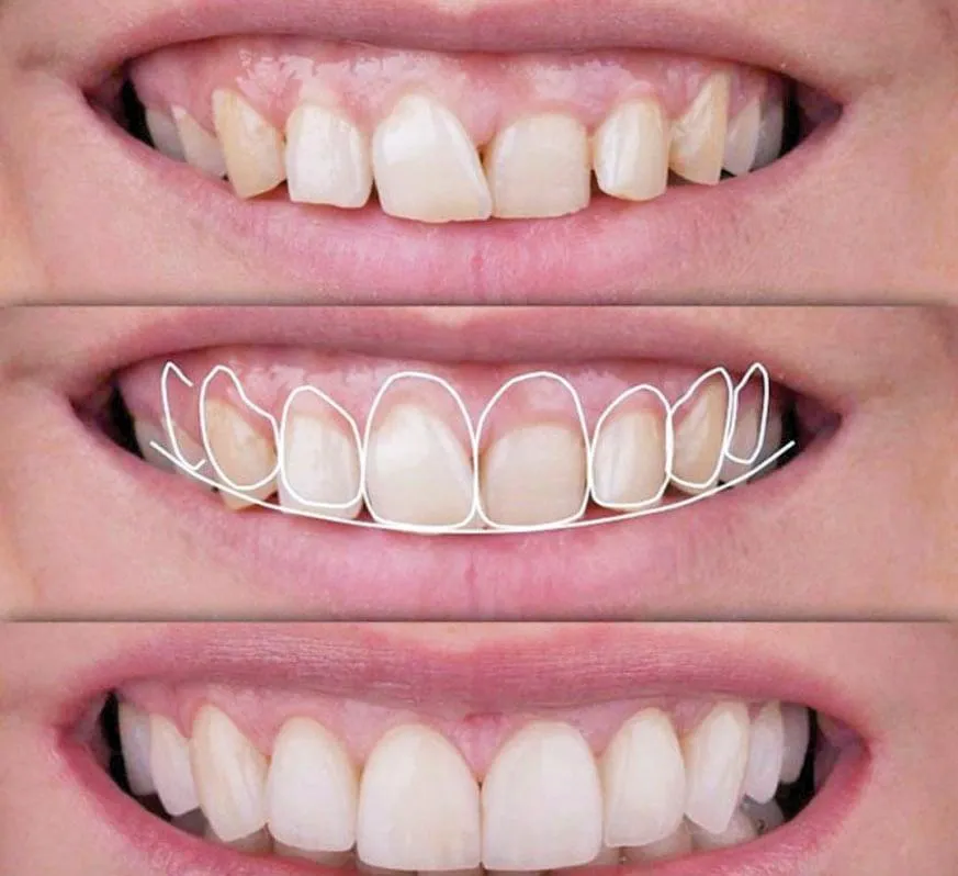 Smile design  image 1