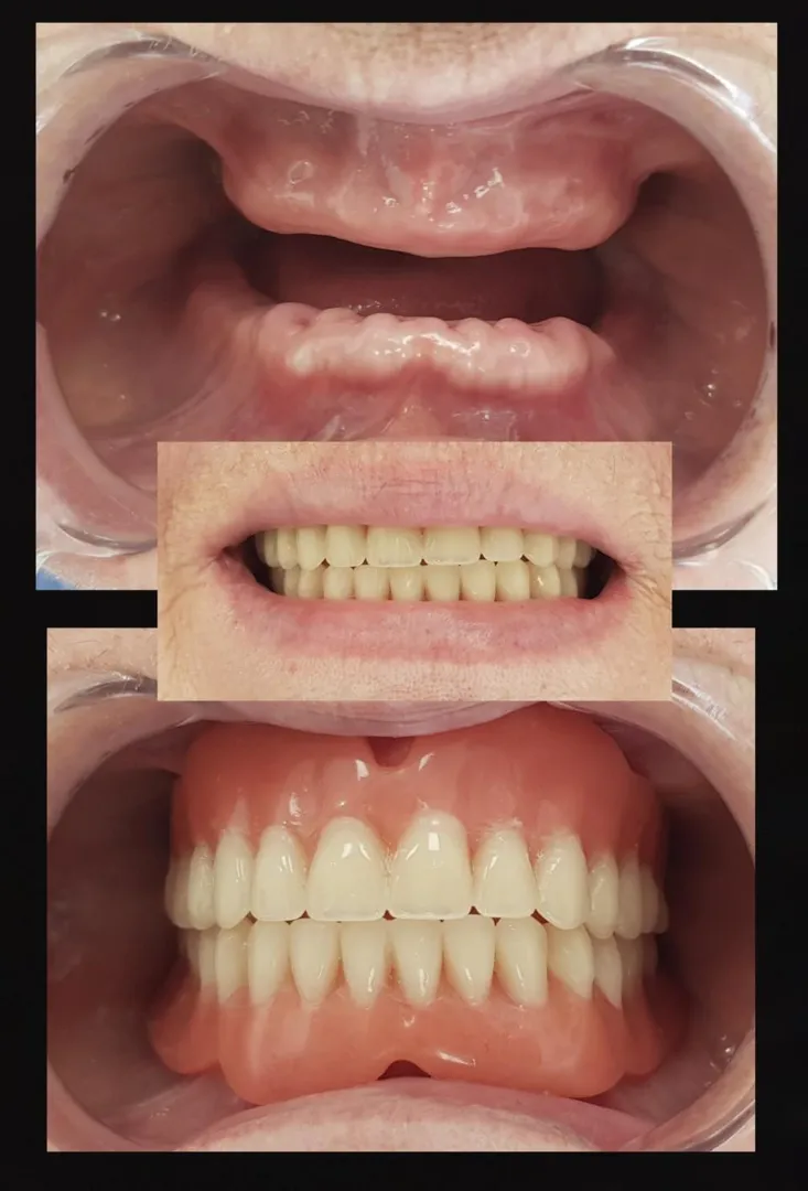 Dentures (Complete & Partial) image 1