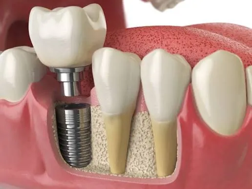 DENTAL IMPLANTS image 1