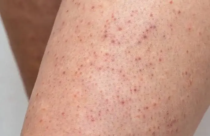 keratosis pilaris image 1