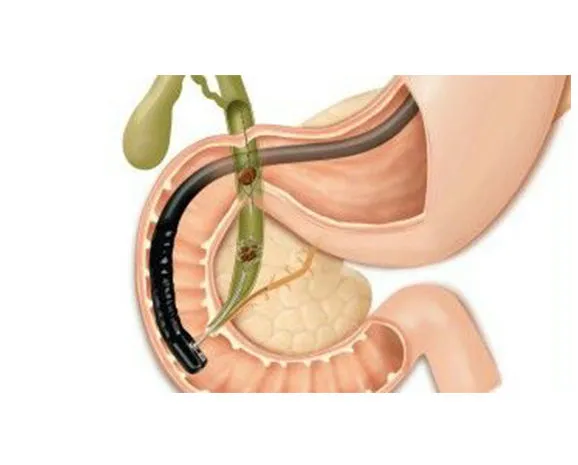 ERCP Treatment Doctor in Baner, Balewadi, Pune image 1