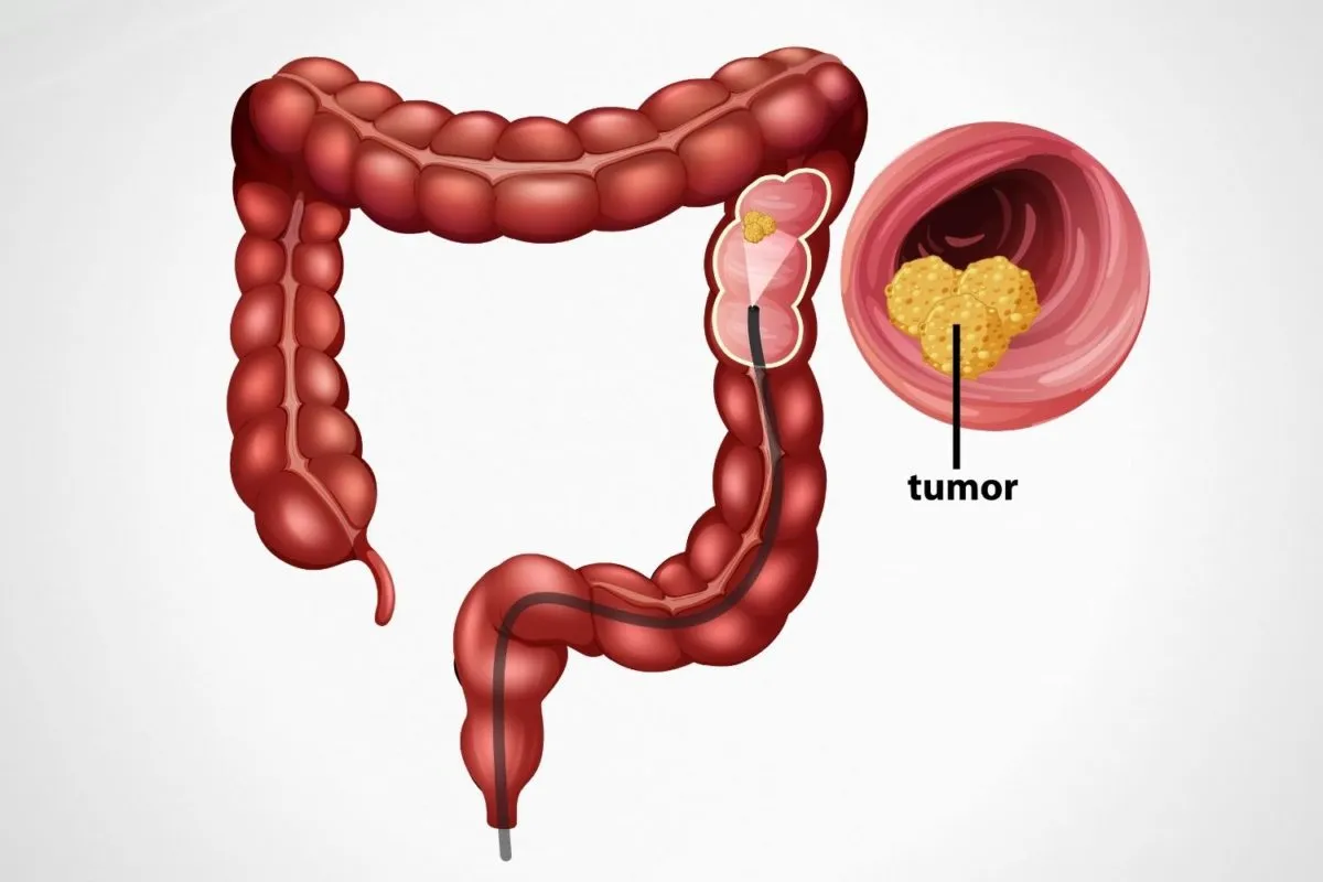 Colonoscopy Treatment Doctor in Baner, Balewadi, Pune image 1