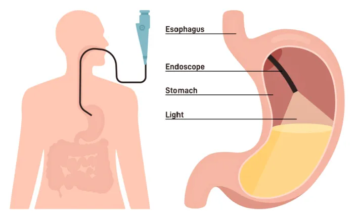 Upper GI Endoscopy Doctor in Baner, Balewadi, Pune image 1