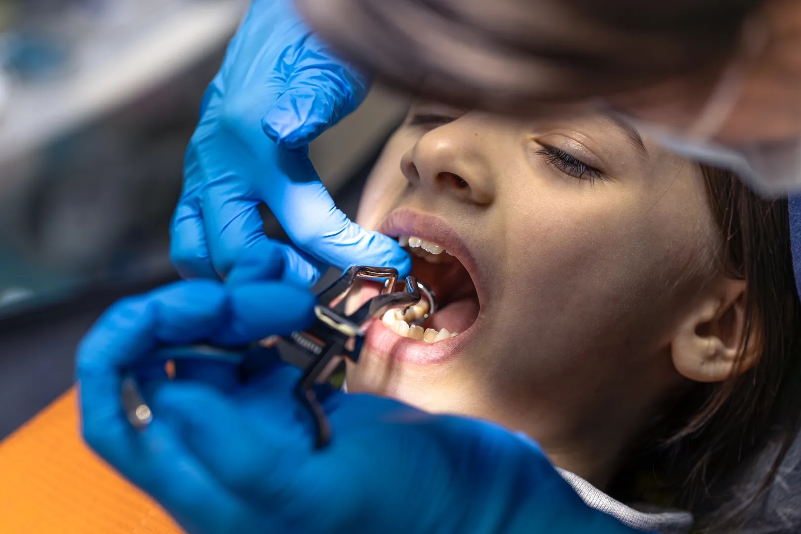 Wisdom Tooth Removal Treatment & Tooth Extractions image 1