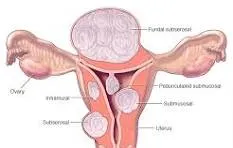 Fibroids & PCOD image 1