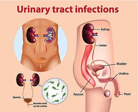 Urinary Tract Infection  image 1