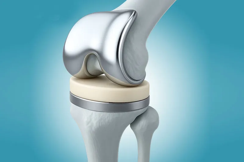 Joint Replacement image 1