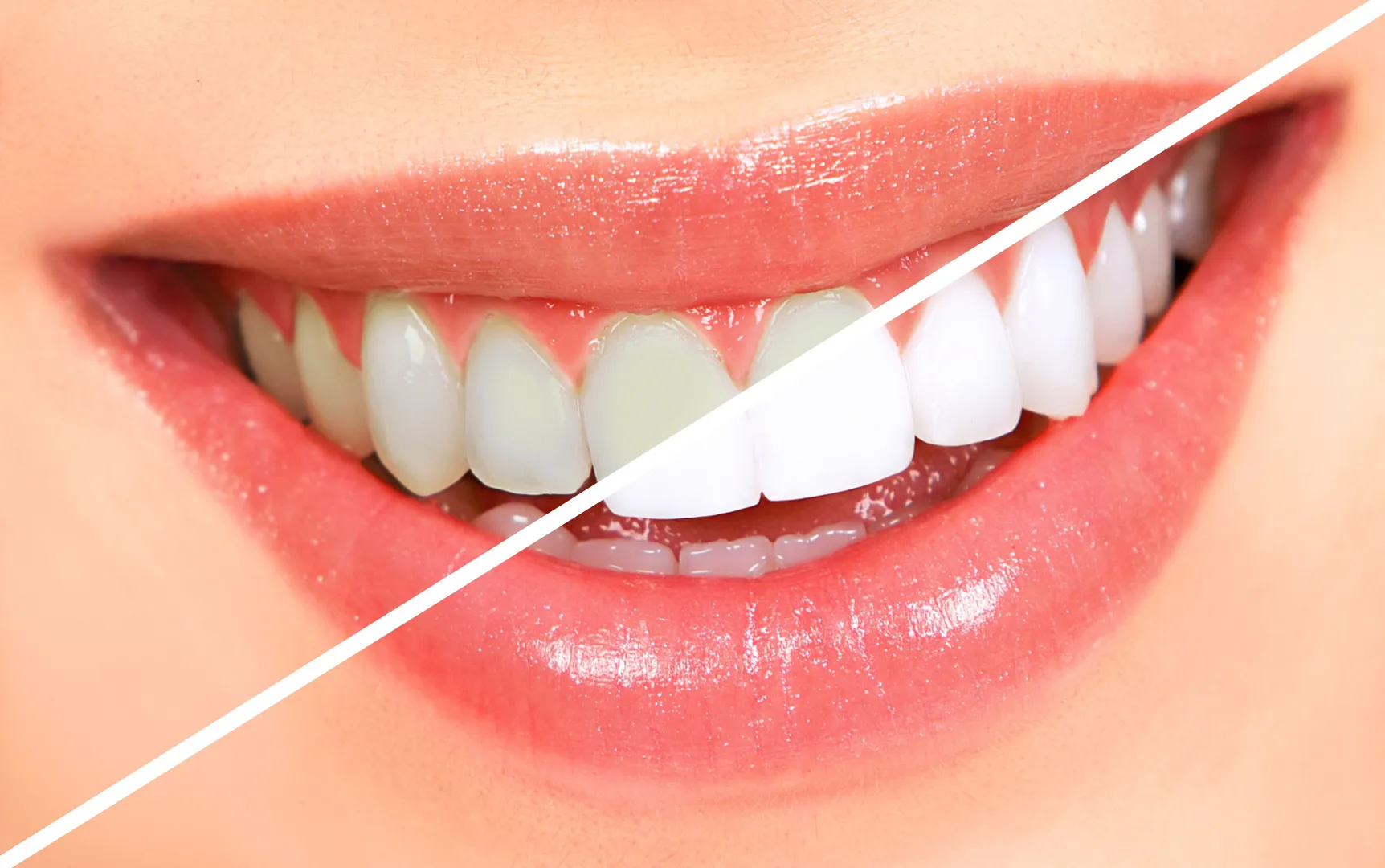 Teeth Whitening Treatment image 1