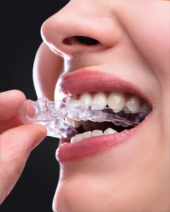 Aligners Treatment/ INVISALIGN image 1