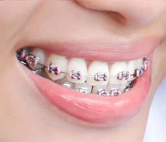 Braces Metal Treatment image 1
