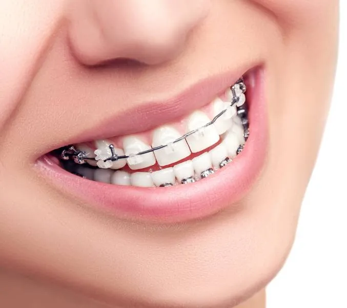 Braces Ceramic Treatment image 1