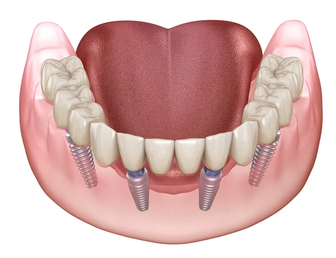 Full Mouth Rehabilitation image 1
