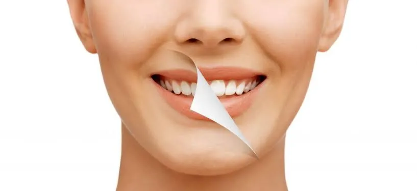 Smile Makeovers(Veneers & Teeth Whitening) image 1