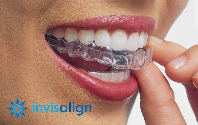 Invisalign image 1