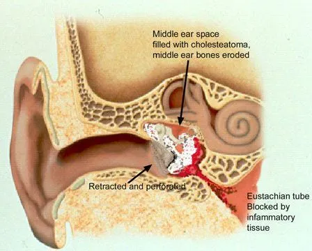 Mastoidectomy image 1