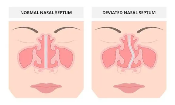 Deviated Septum Surgeries image 1