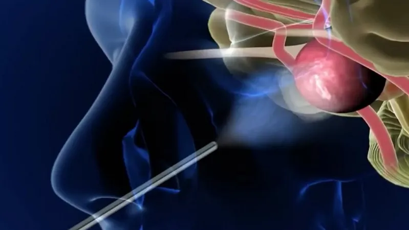 Endonasal DCR image 1