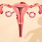 Endometriosis image 1