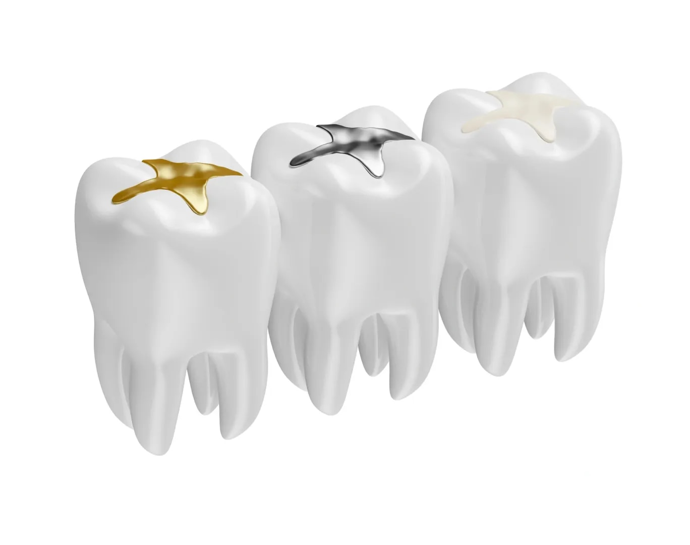 Dental Fillings for Repairing Teeth and Preventing Further Decay image 1