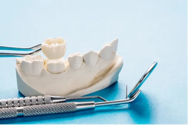 Dental Crowns (Teeth Caps) image 1