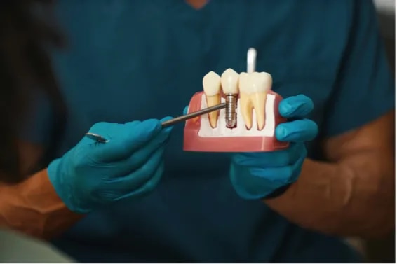 Dental Implants image 1
