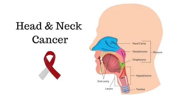 Head & Neck Cancer image 1