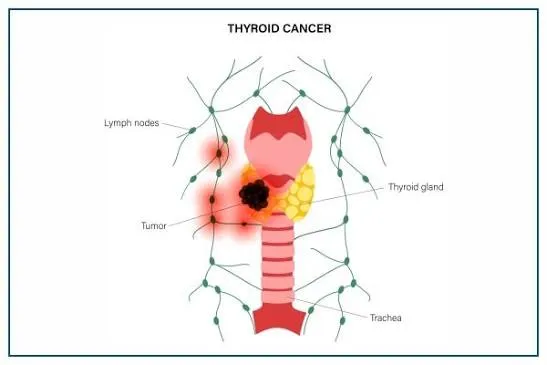 Thyroid Cancer image 1