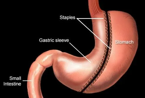 Sleeve Gastrectomy image 1