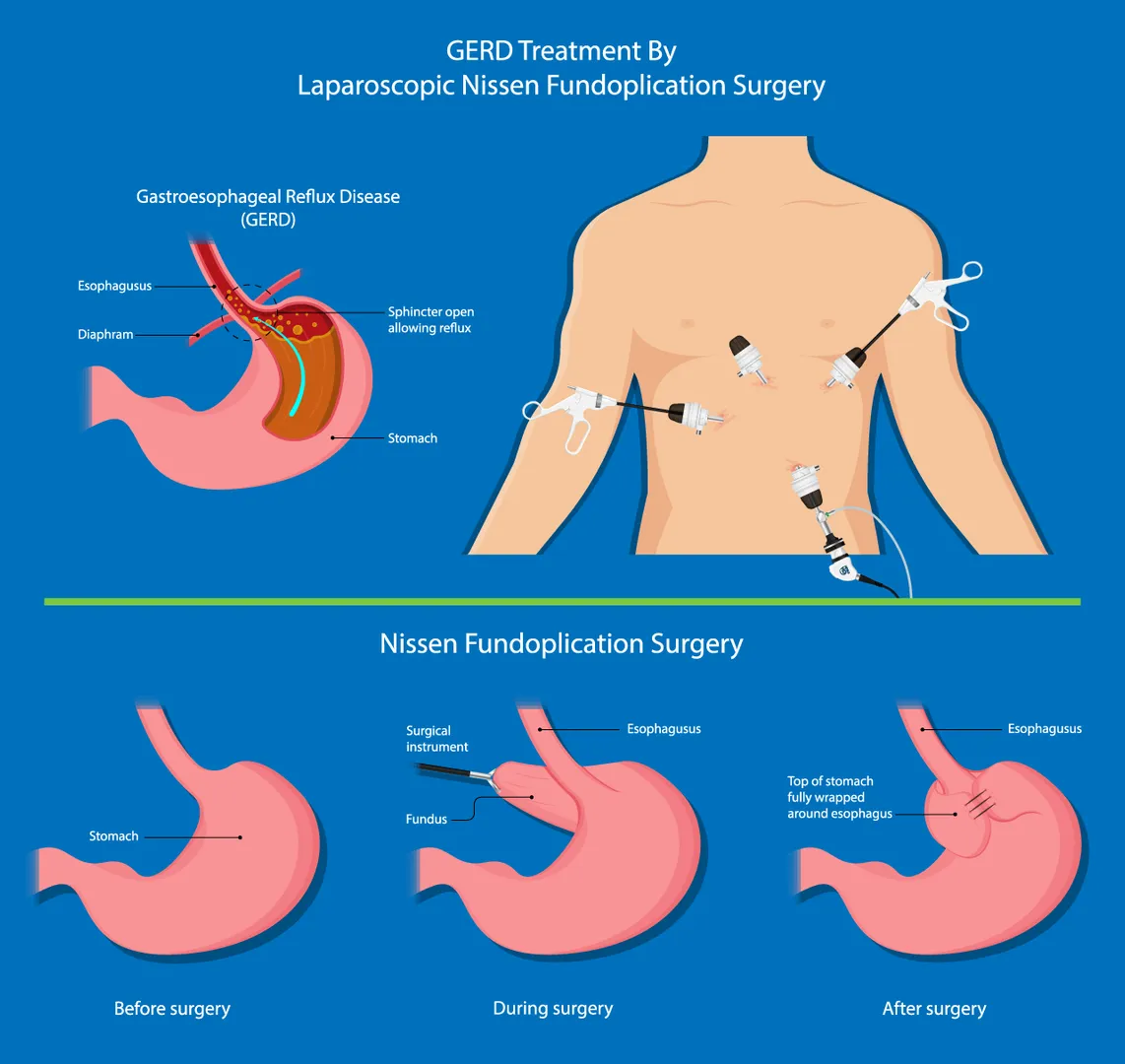 Anti-Reflux Surgery for GERD and Hiatus Hernia image 1