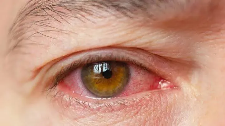 Dry eye  image 1