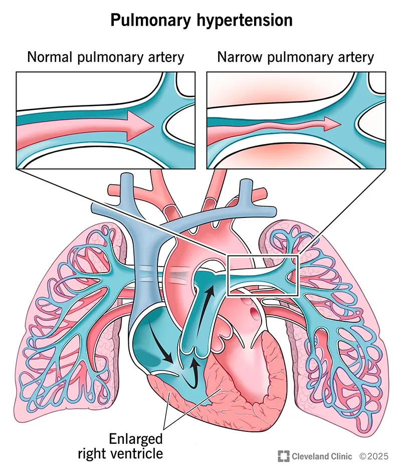 Pulmonary Hypertension Tretments – Dr. Sanjay Gabhale image 1