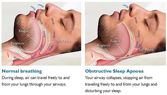 Sleep-Disordered Breathing image 1