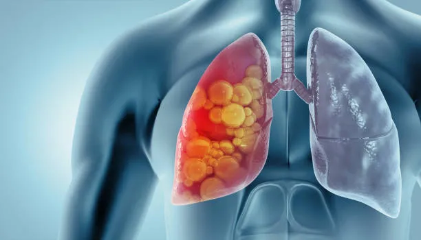 Lung Cancer Treatment  image 1