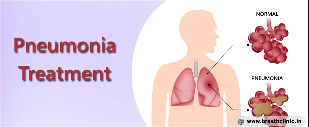 Pneumonia Treatment – Dr. Sanjay Gabhale, Chest Clinic Moshi image 1