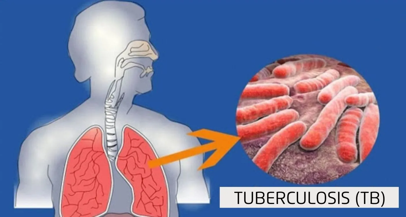 Tuberculosis (TB) Treatment – Dr. Sanjay Gabhale, Chest Clinic Moshi image 1
