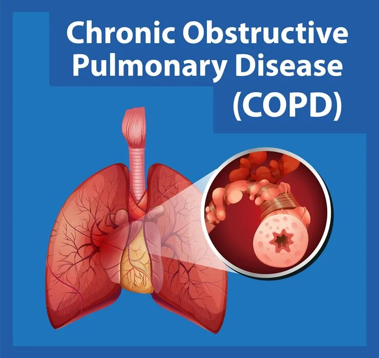COPD Treatment  image 1