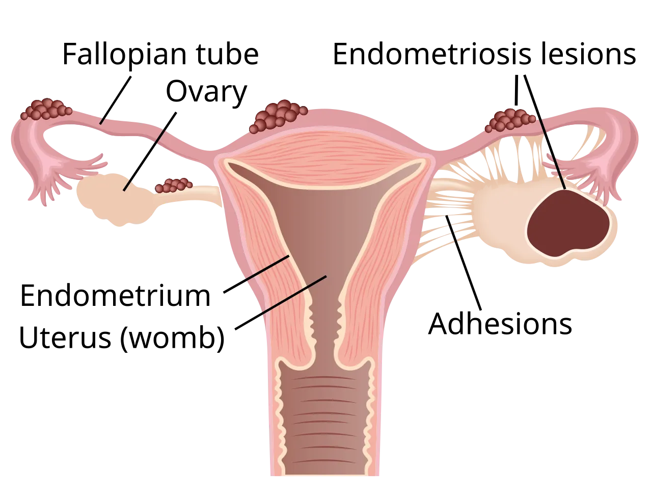 Endometriosis Treatment image 1