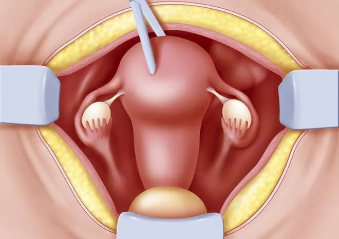 Uterus Removal Surgery image 1