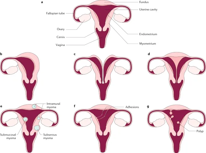 Recurrent Miscarriage Treatment image 1