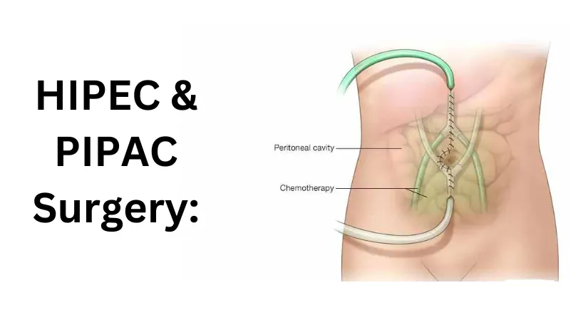 HIPEC/PIPAC procedures image 1