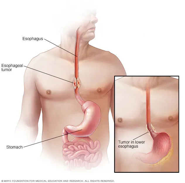 Esophageal cancer image 1